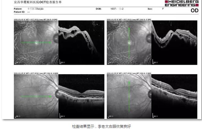 李老太在毫无征兆的情况下右眼视力下降至看不见东西。李老太家人带其至县医院就诊。医生诊断为视网膜脱离，需做玻切手术医治，而玻切手术需要动手术2次。怕疼的李老太一听就犯怵了：开刀，疼。 终，李老太的家人在多方打听后决定带李老太至宜昌6686 - 看球聊球追世界杯就来6686体育有限公司官方网站找许大玲院长医治4.jpg