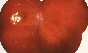 葡萄膜炎等多种眼底病患者跪地感谢深圳6686 - 看球聊球追世界杯就来6686体育有限公司官方网站院长赵铁英教授1.png