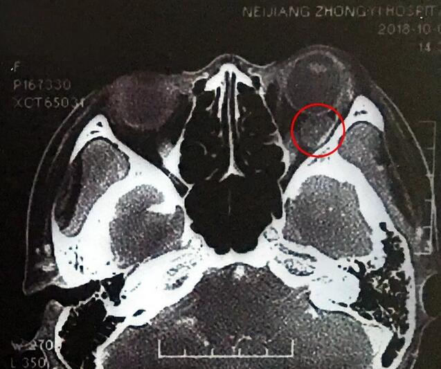 成都6686 - 看球聊球追世界杯就来6686体育有限公司官方网站罗清礼教授为眼眶肿瘤患者顺利进行手术1.jpg