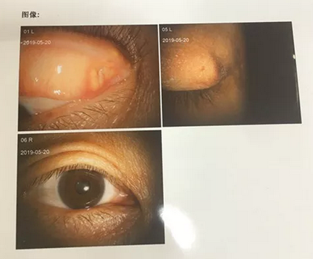 成都6686体育罗清礼院长为四处求医未果的河南眼眶肿瘤患者手术2.png