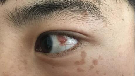 四川丹巴15岁男孩患结膜血管瘤，在成都6686 - 看球聊球追世界杯就来6686体育有限公司官方网站顺利手术1.jpg