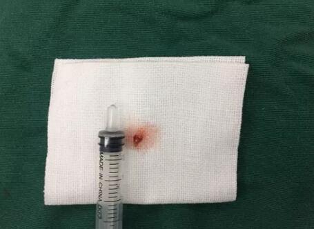 四川丹巴15岁男孩患结膜血管瘤，在成都6686 - 看球聊球追世界杯就来6686体育有限公司官方网站顺利手术3.jpg