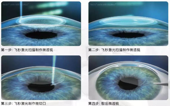 2020高考视力受限专业有哪些？来听听6686体育近视手术医生的建议1.png