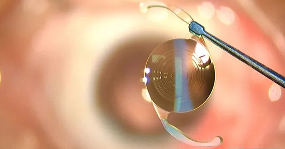 成都6686 - 看球聊球追世界杯就来6686体育有限公司官方网站开展了医院首例白内障爱尔康三焦点人工晶体植入术.png